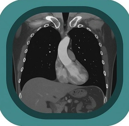ct chest mediastinal window anatomy icon